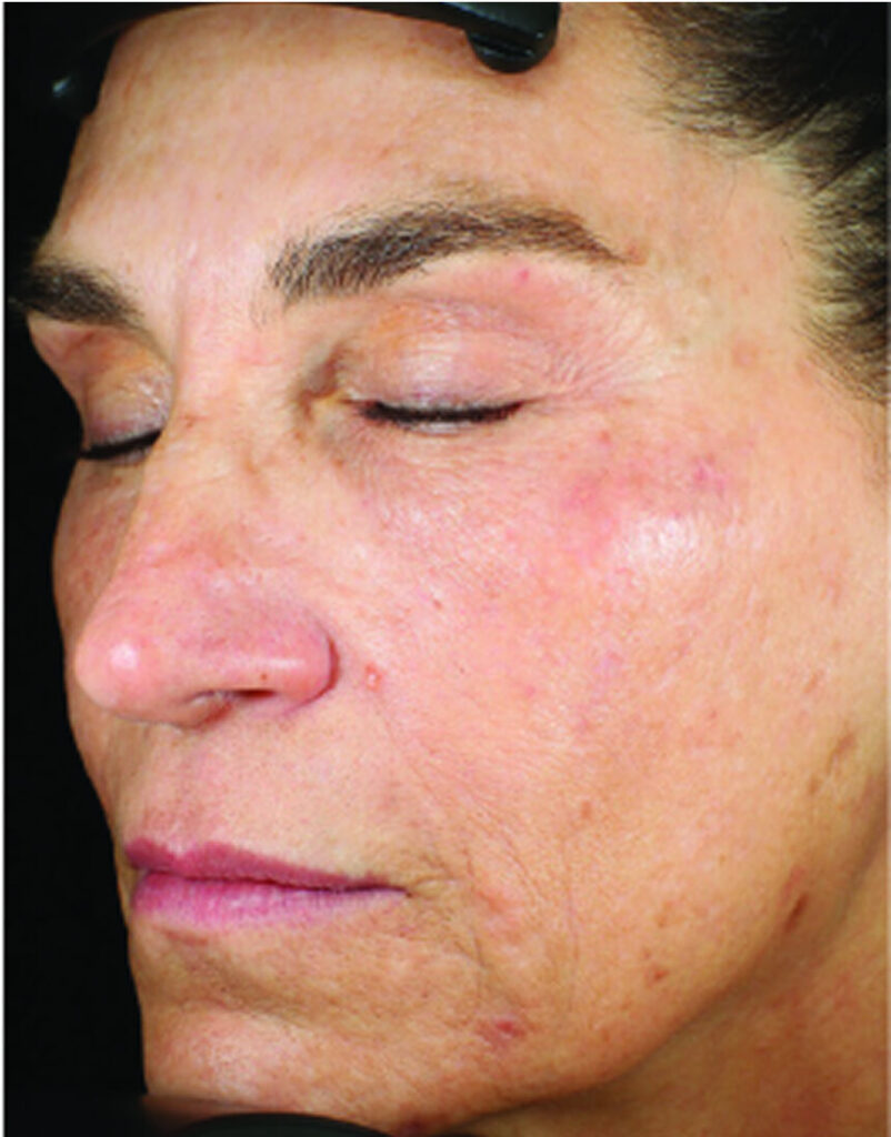 Portrait of woman post-microneedling, 30 days after