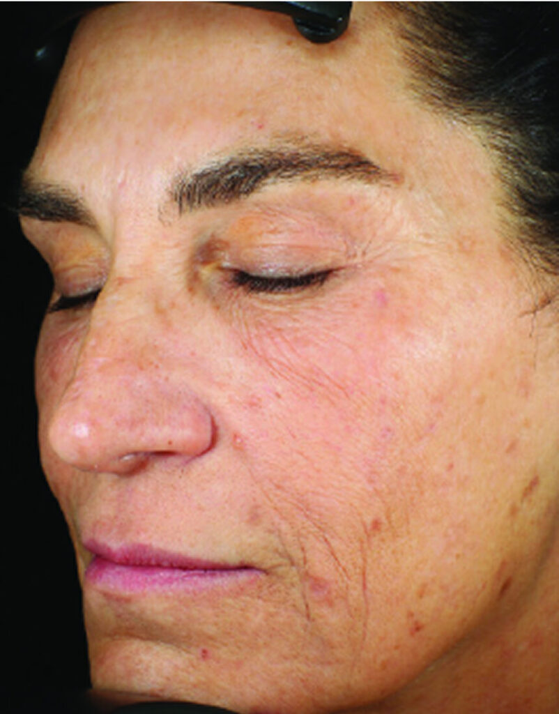 Portrait of woman post-microneedling, immediately after
