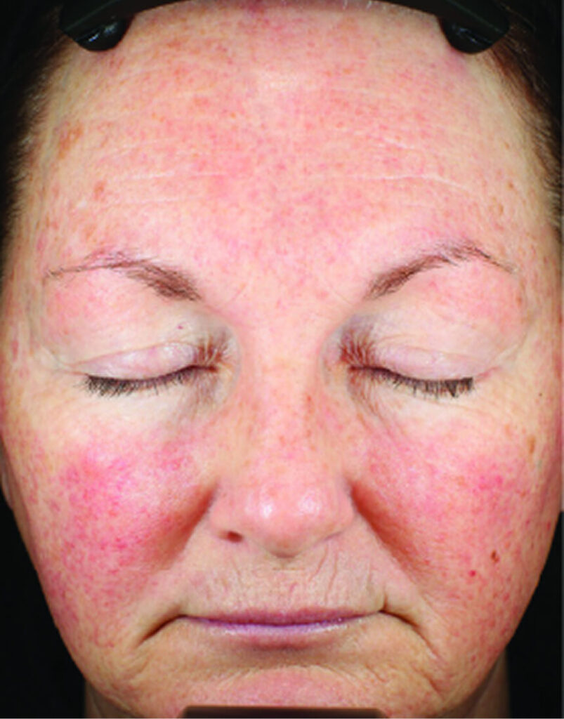 Portrait of woman post-microneedling, 30 days after