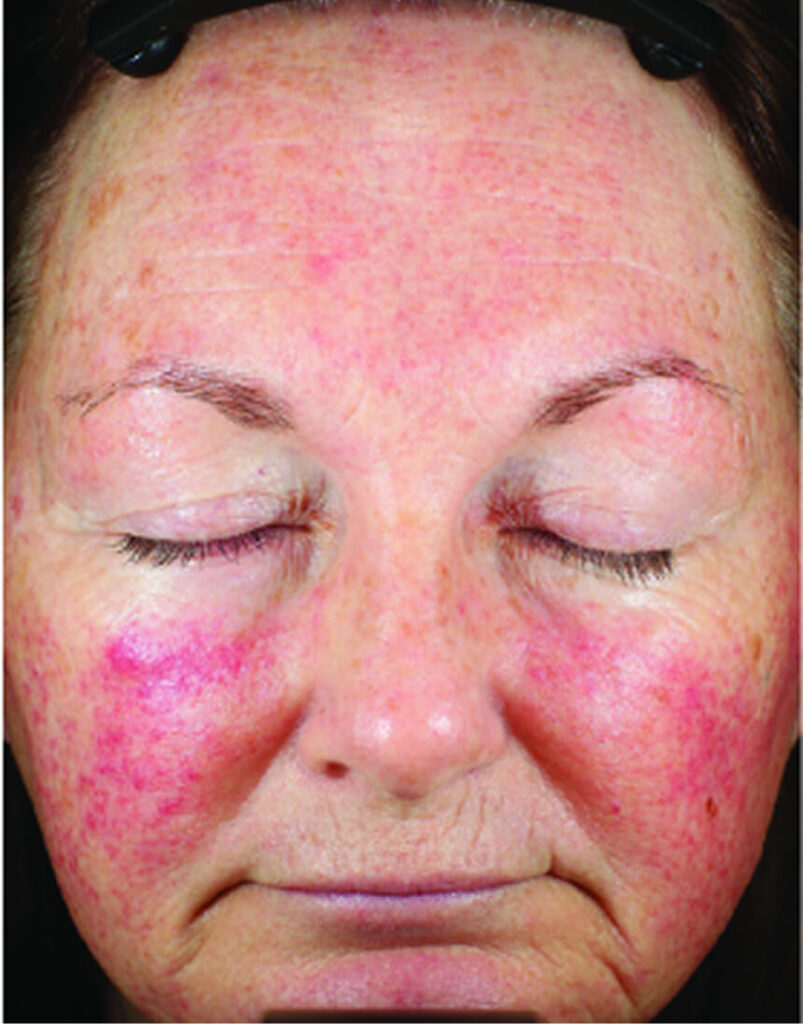 Portrait of woman post-microneedling, immediately after