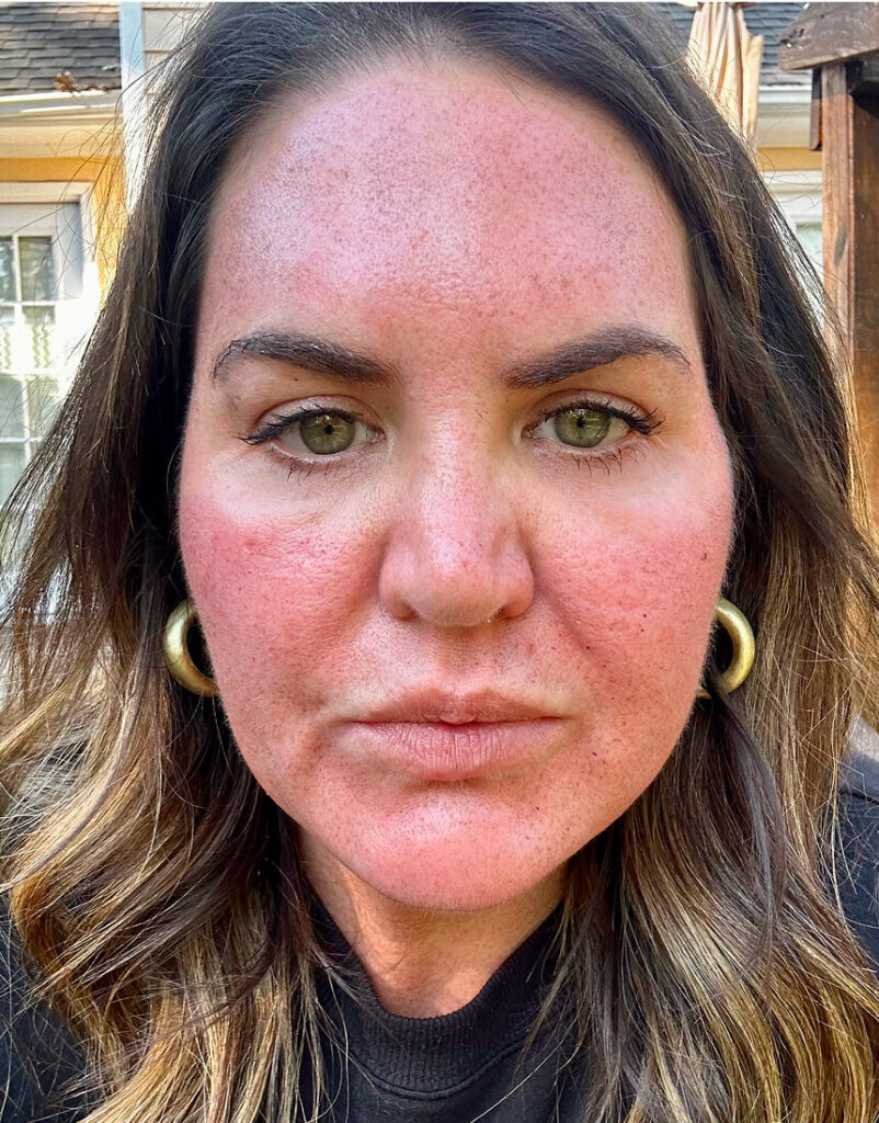 Portrait of woman post-microneedling, 1 day after
