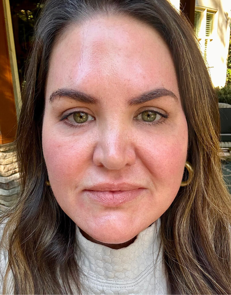 Portrait of woman post-microneedling, 3 days after