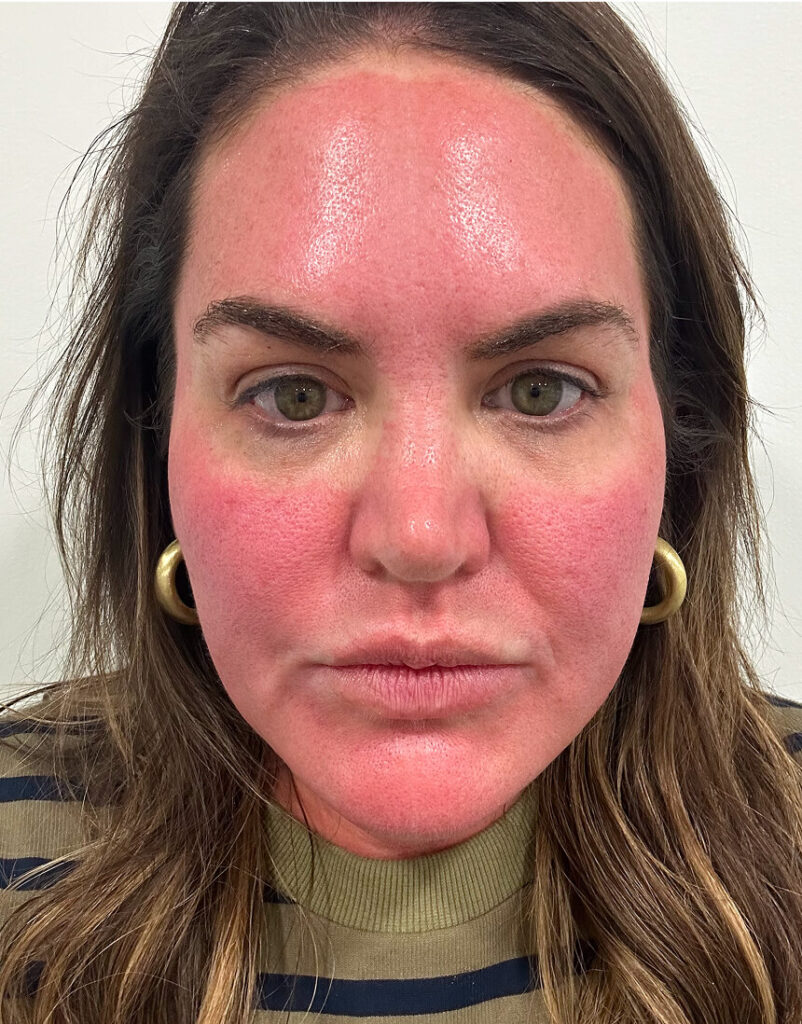 Portrait of woman post-microneedling, immediately after