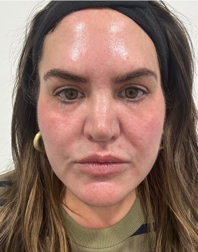 Portrait of woman before microneedling