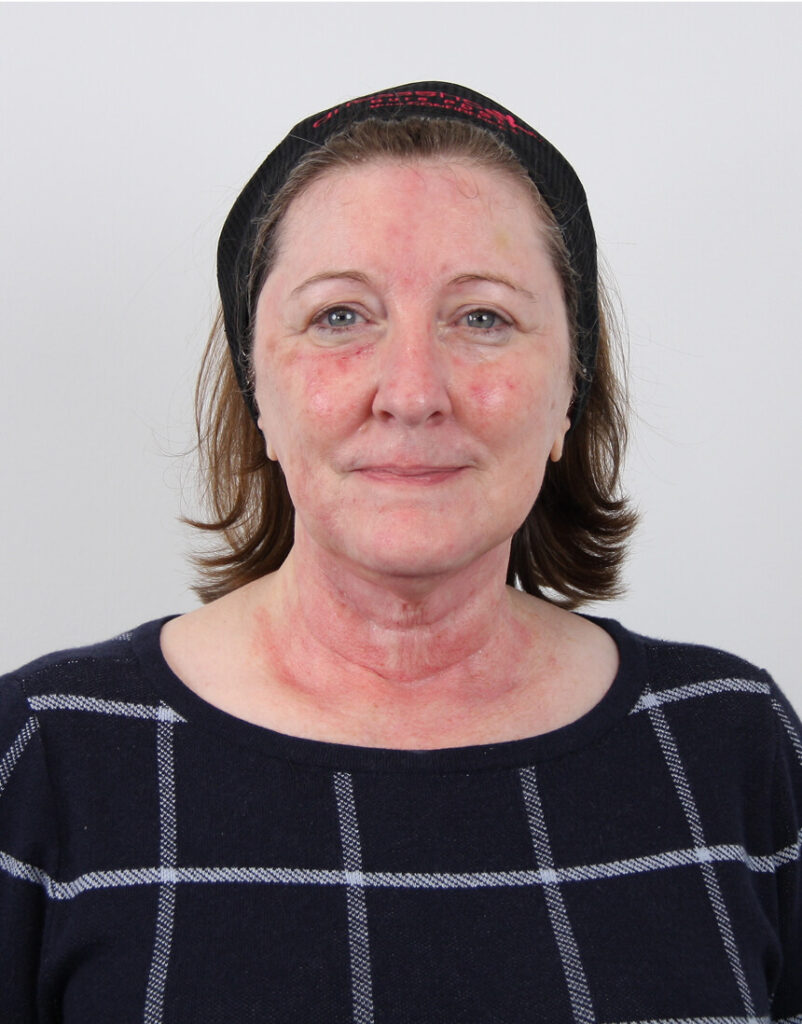 Portrait of woman post-microneedling, 1 hour after