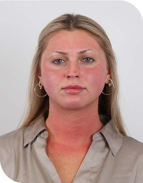 A photo of a woman post-microneedling, 1 hour after