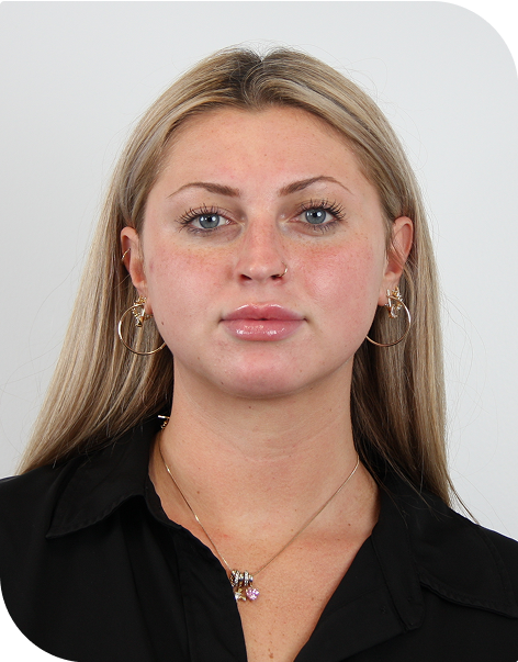 A woman post-microneedling, one day after