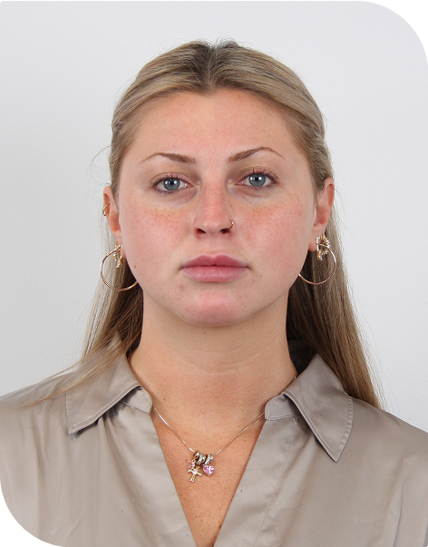 A photo of a woman before microneedling