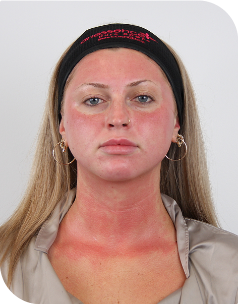 A photo of a woman post-microneedling, immediately after