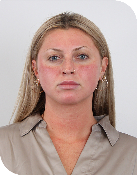 Photo of microneedling customer, 3 hours post-procedure