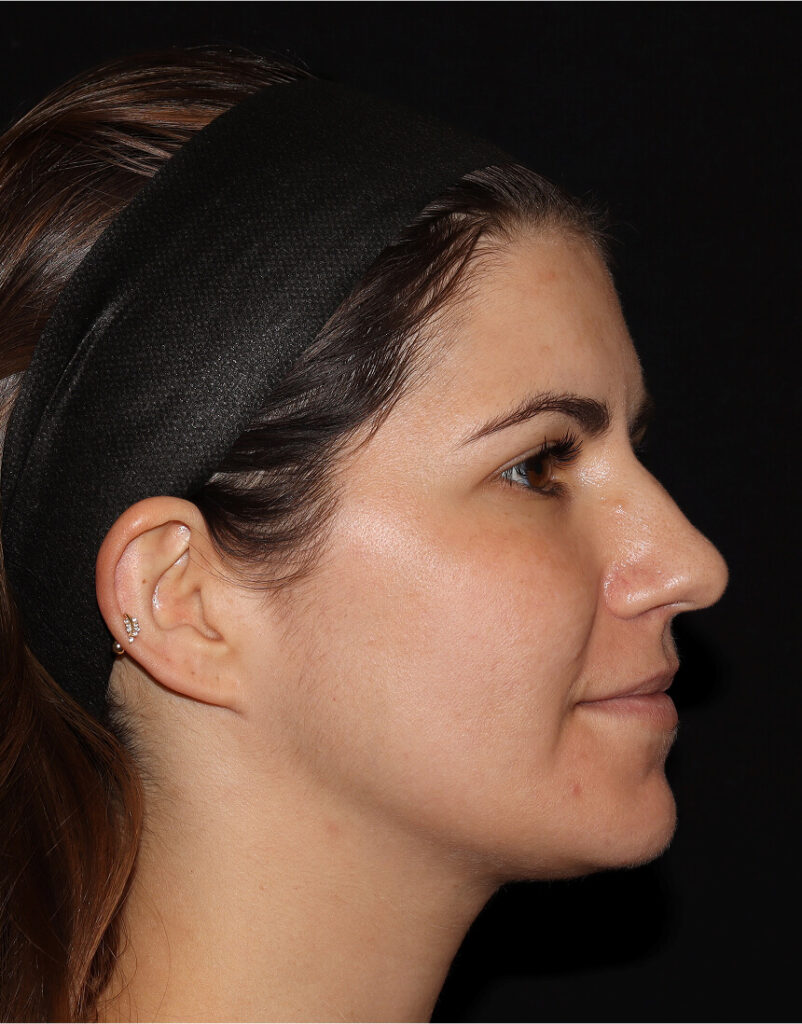 Portrait of woman post-microneedling, 7 days after