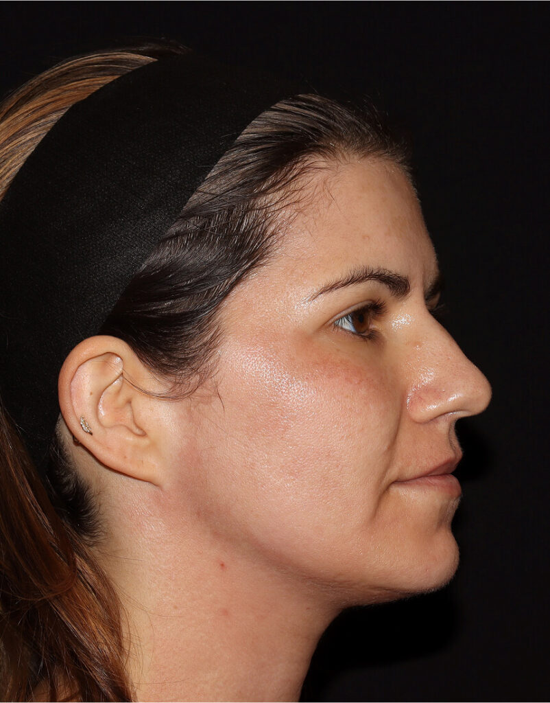 Portrait of woman post-microneedling, immediately after