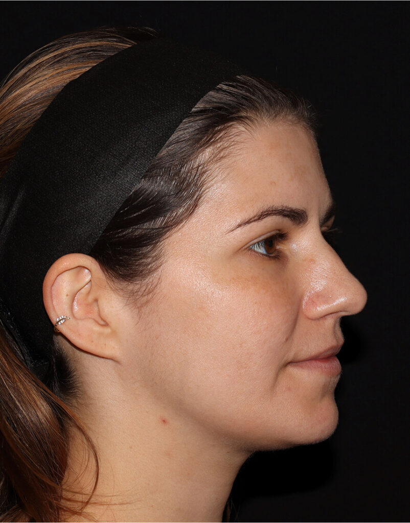 Portrait of woman before microneedling