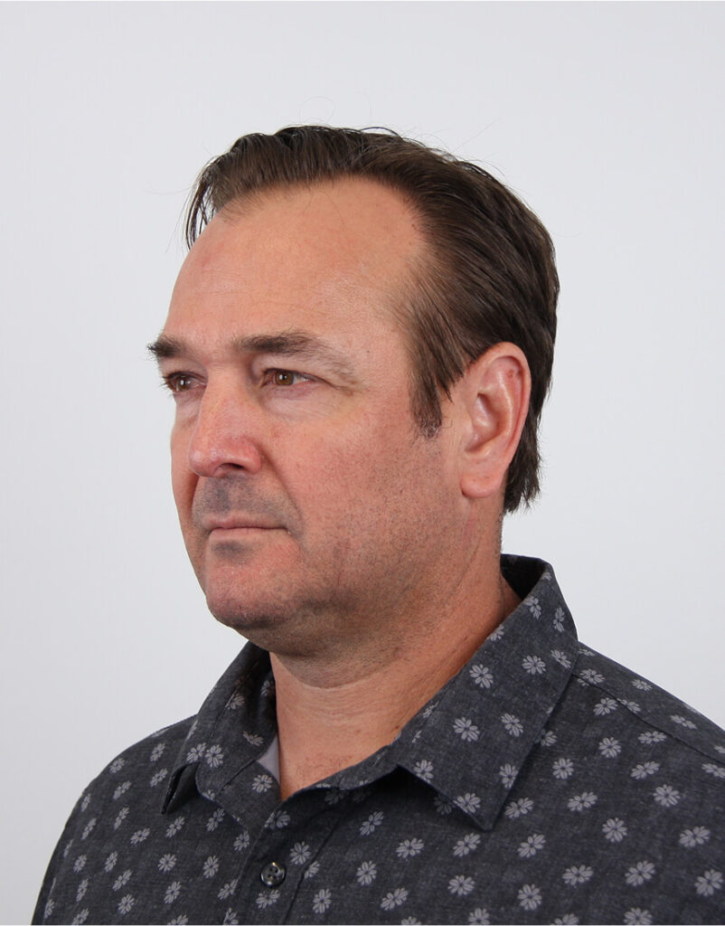 Portrait of man post-microneedling, 1 day after