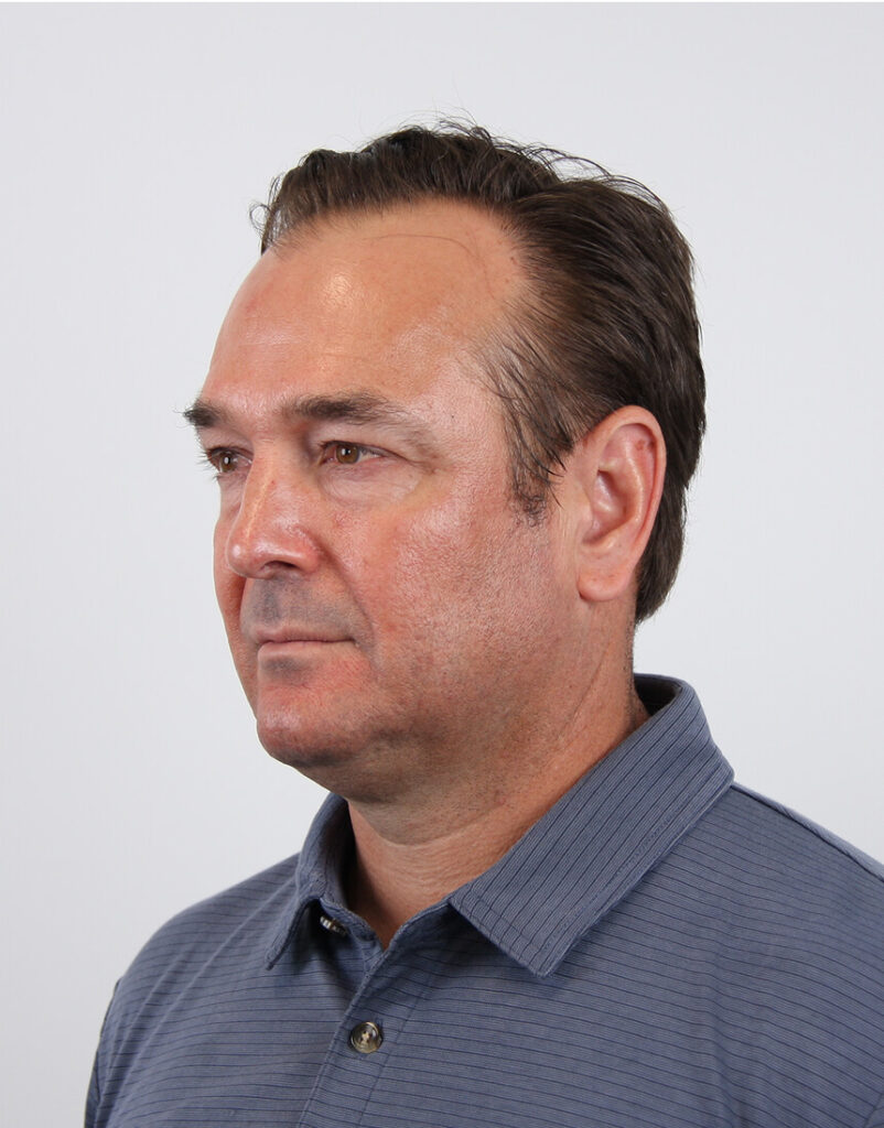 Portrait of man post-microneedling, 1 hour after