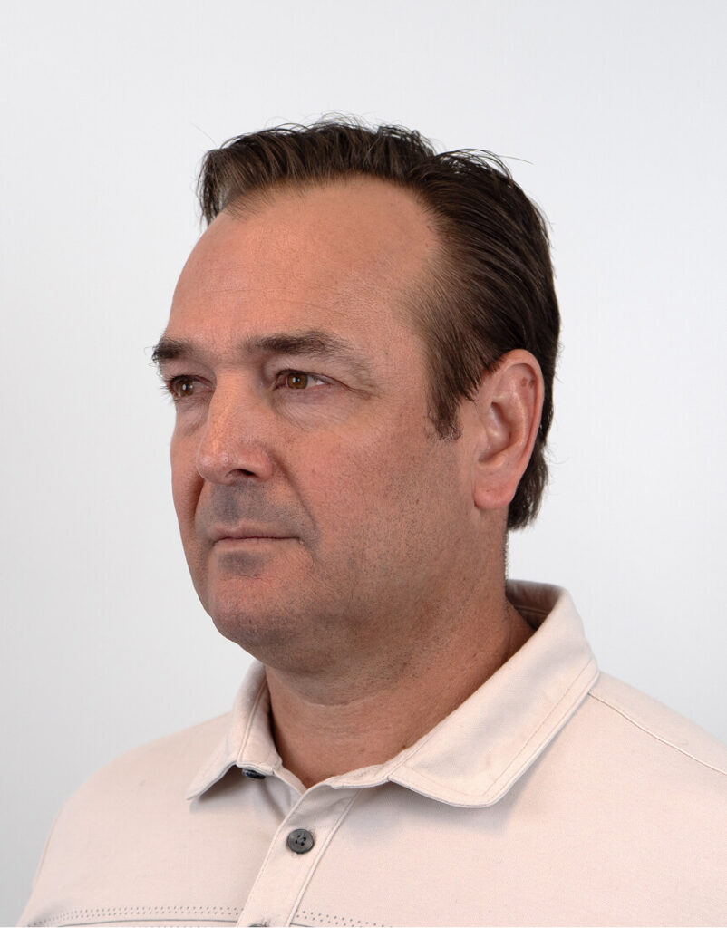 Portrait of man post-microneedling, 7 days after