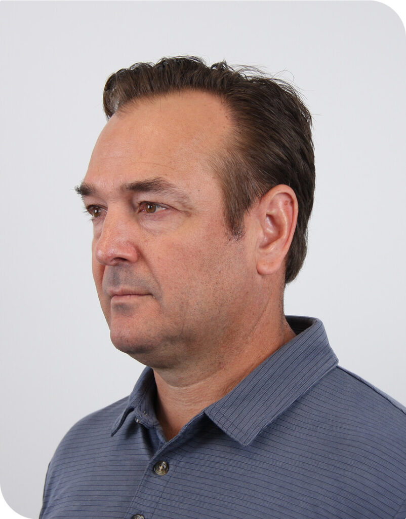 Portrait of man before microneedling