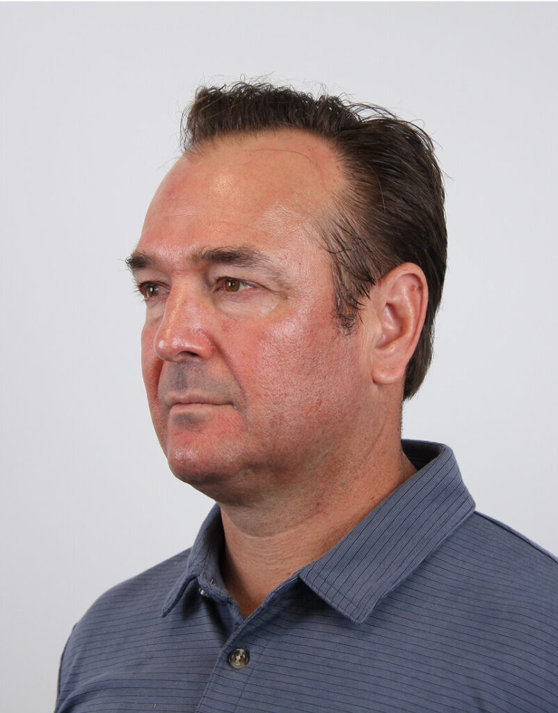 Portrait of man post-microneedling, immediately after