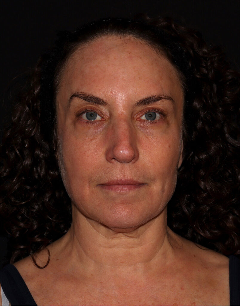 Portrait of woman post-microneedling, 7 days after