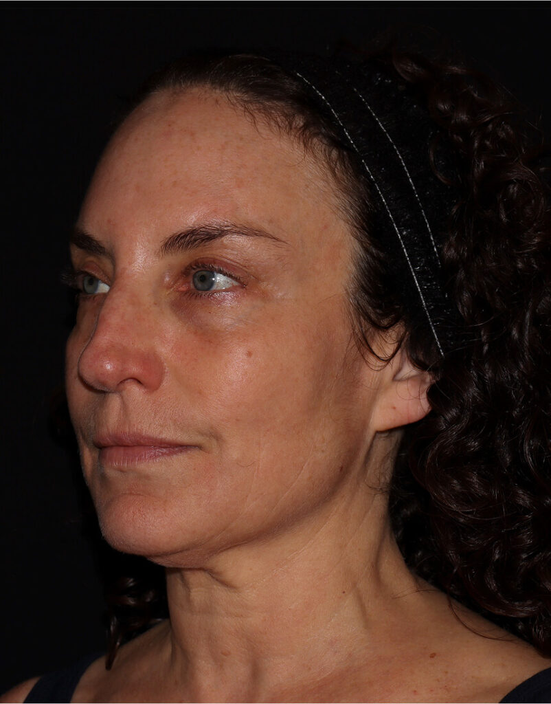 Portrait of woman post-microneedling, 7 days after