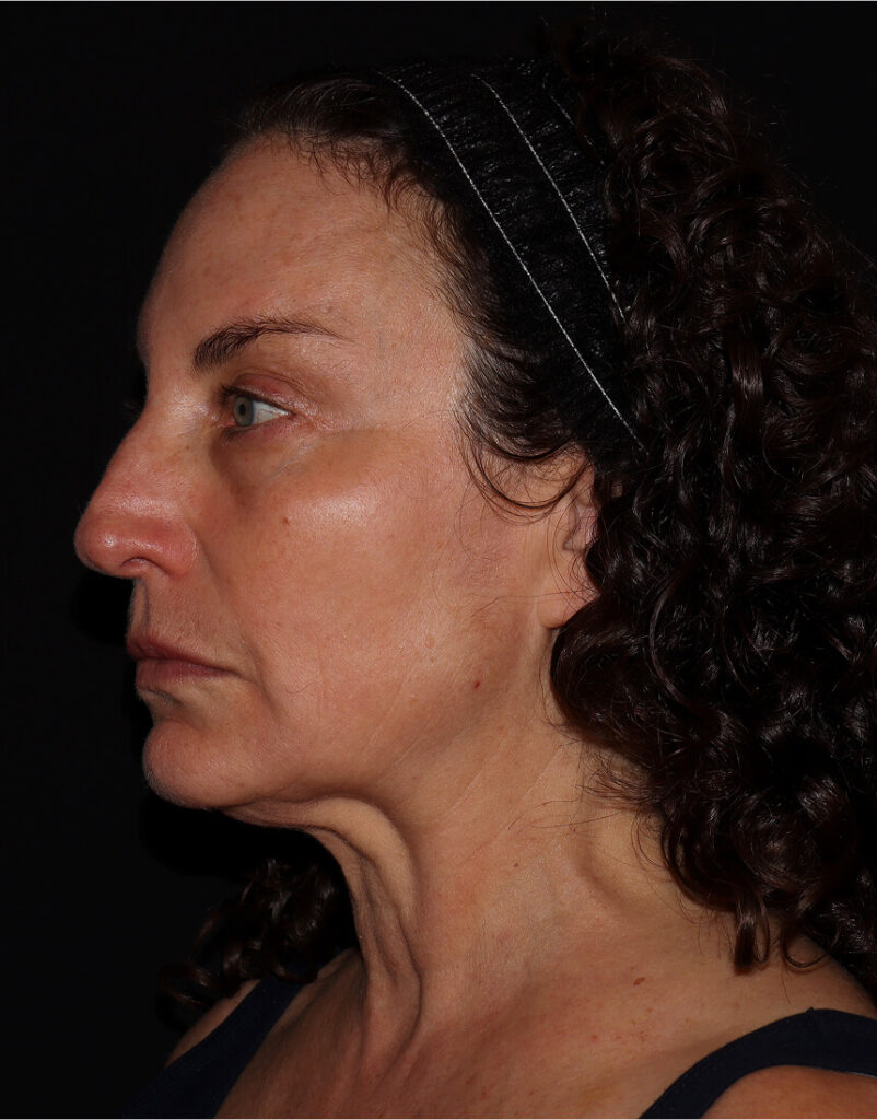 Portrait of woman post-microneedling, 7 days after