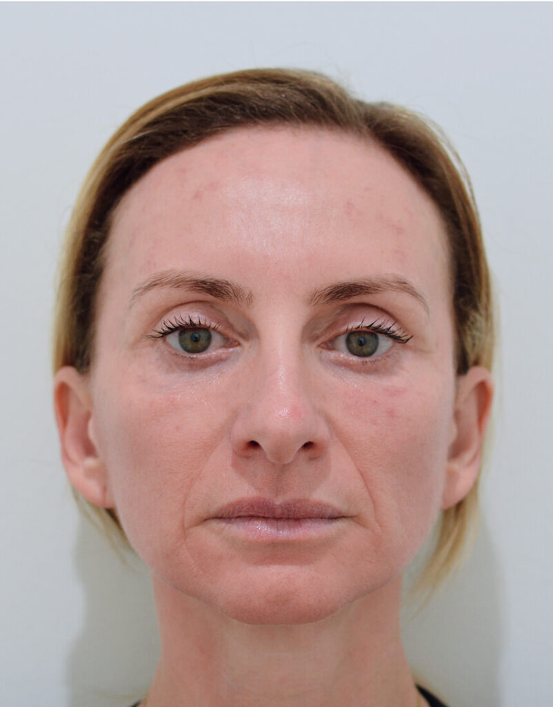 Portrait of woman post-microneedling, 1 day after