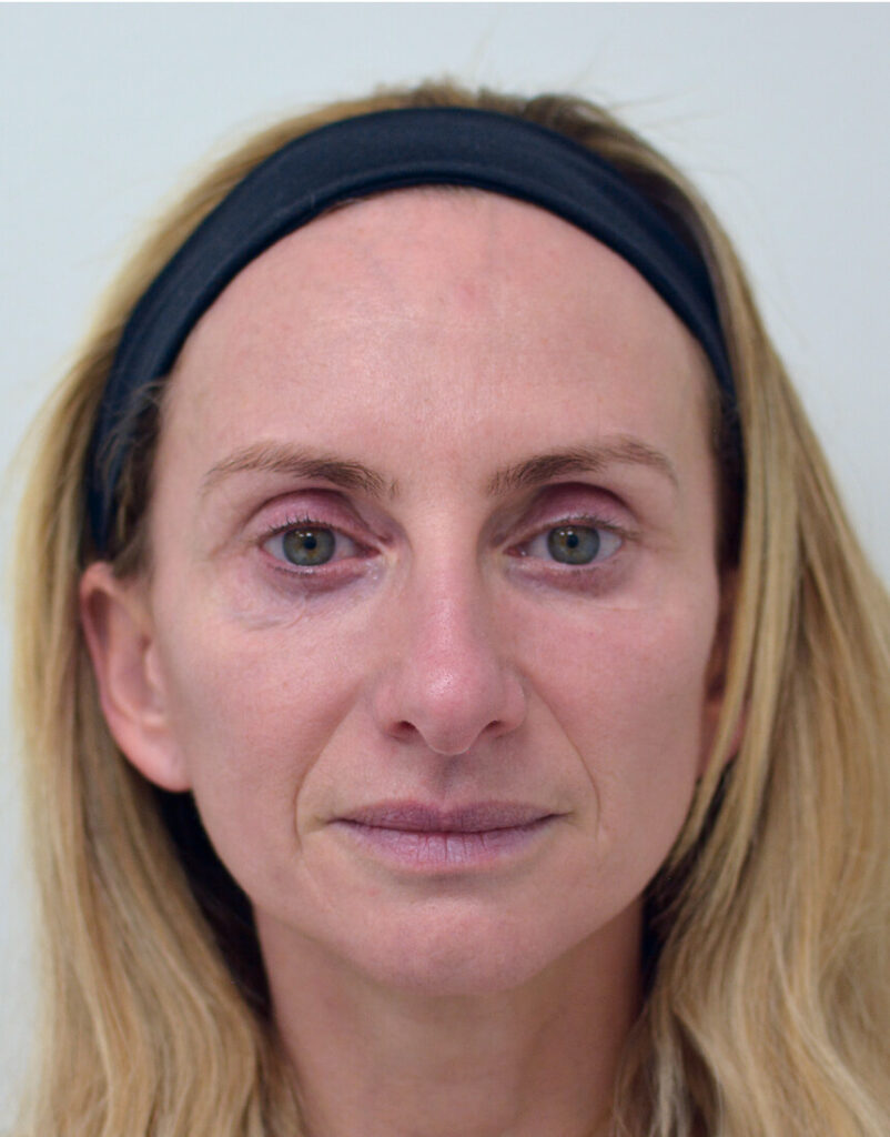 Portrait of woman before microneedling