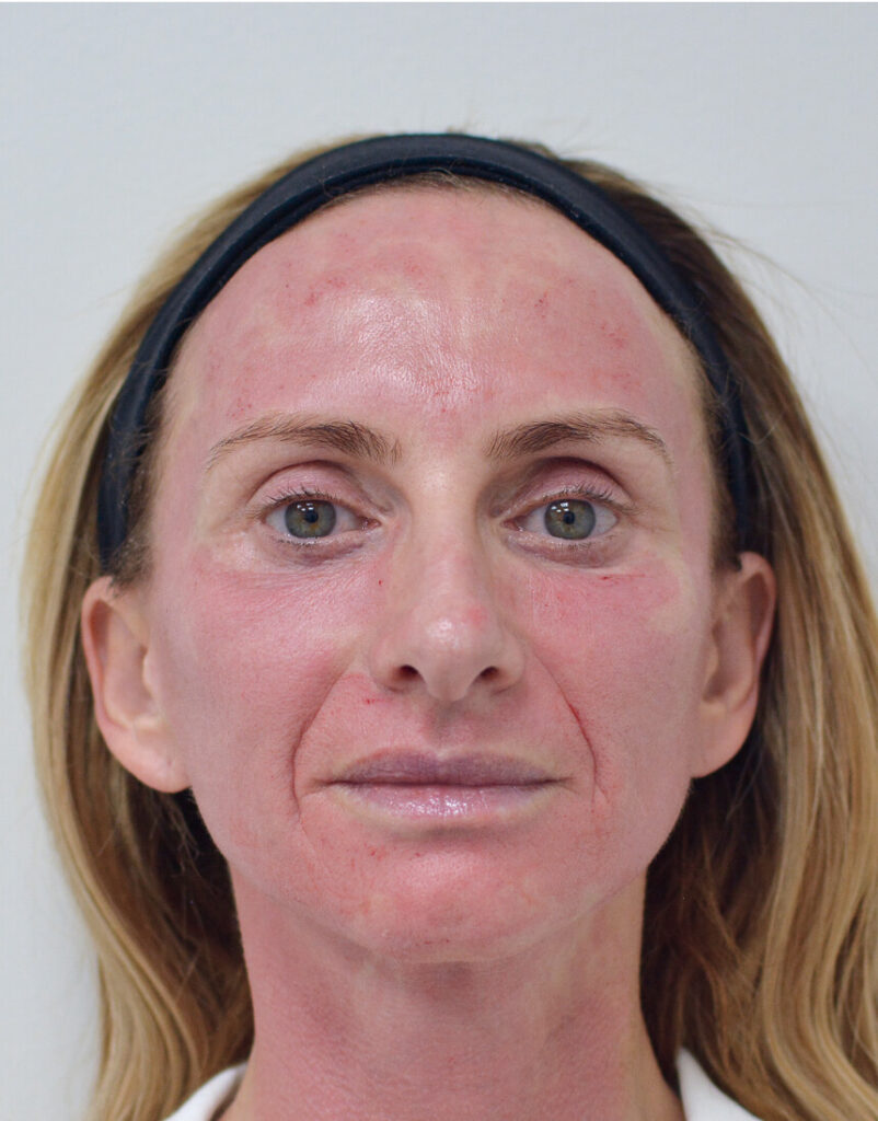 Portrait of woman post-microneedling, immediately after