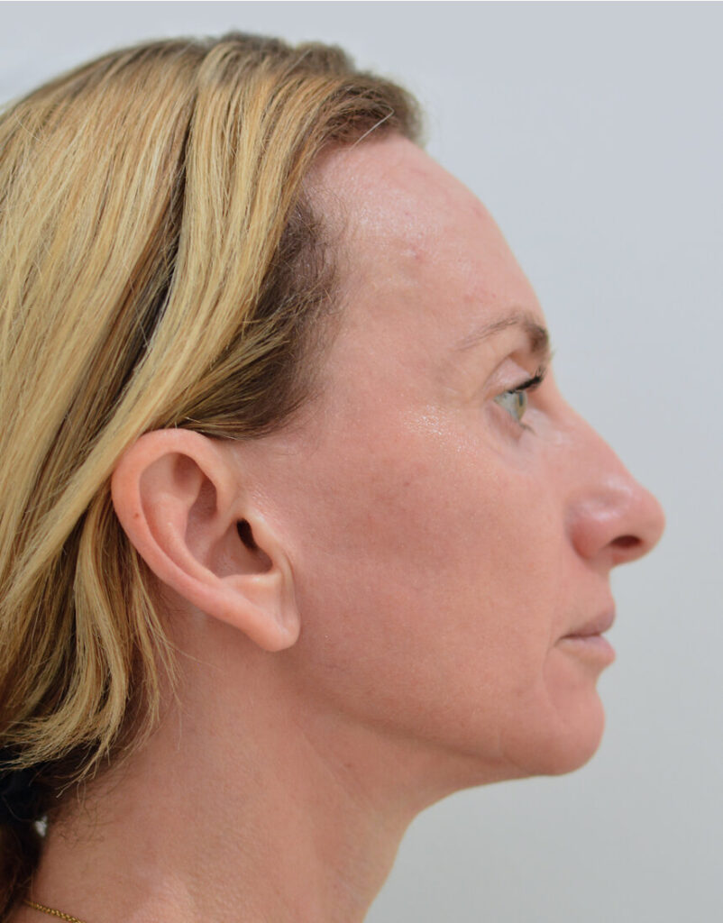 Portrait of woman post-microneedling, 1 day after