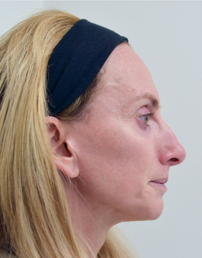 Portrait of woman before microneedling