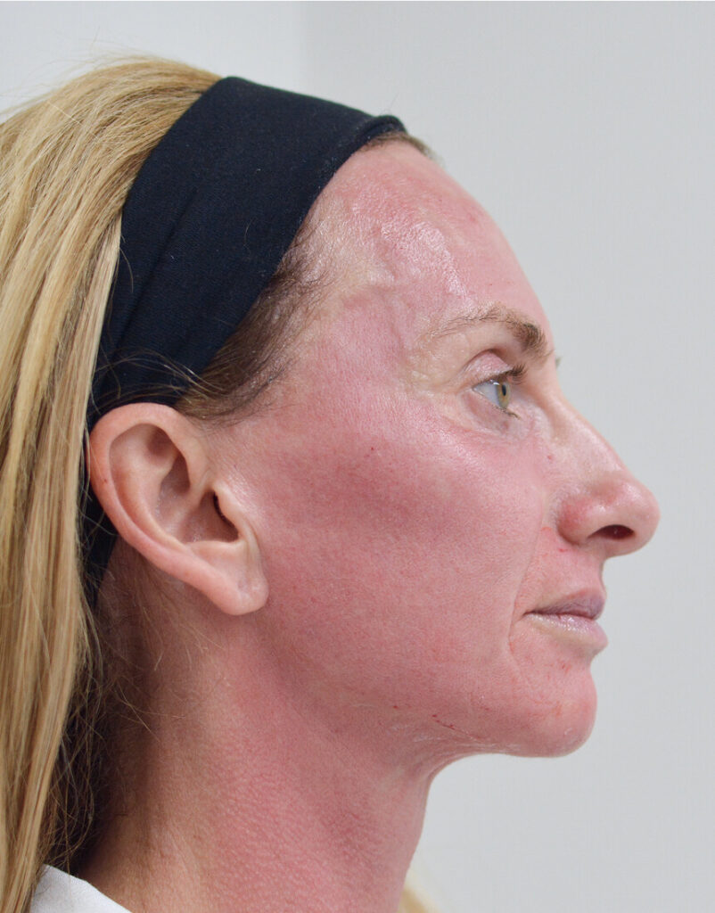 Portrait of woman post-microneedling, immediately after