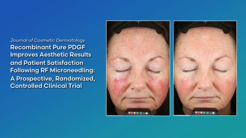 Journal of Cosmetic Dermatology: Recombinant Pure PDGF Improves Aesthetic Results and Patient Satisfaction Following RF Microneedling: A Prospective, Randomized, Controlled Clinical Trial