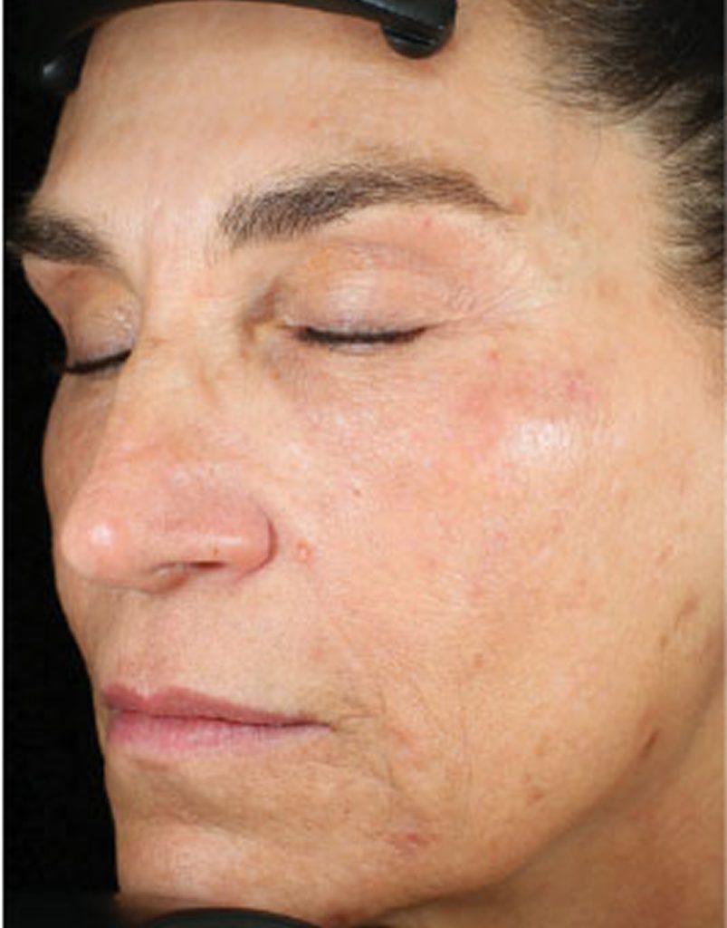 Portrait of woman post-microneedling, 30 days after