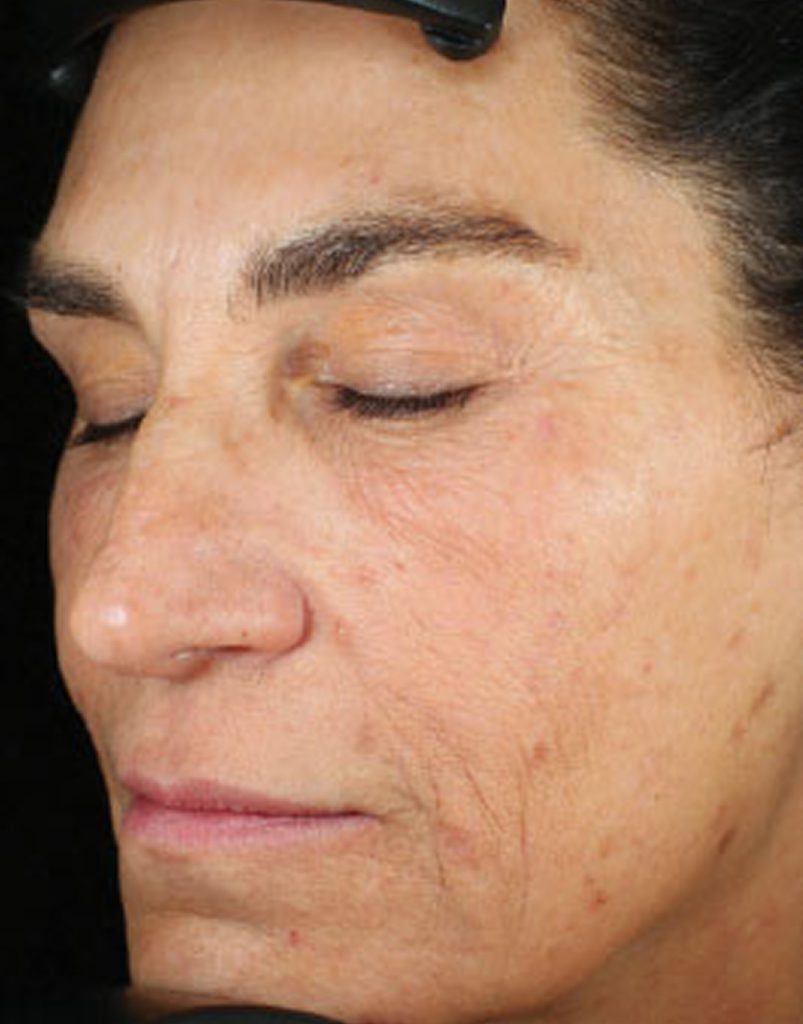 Portrait of woman post-microneedling, immediately after