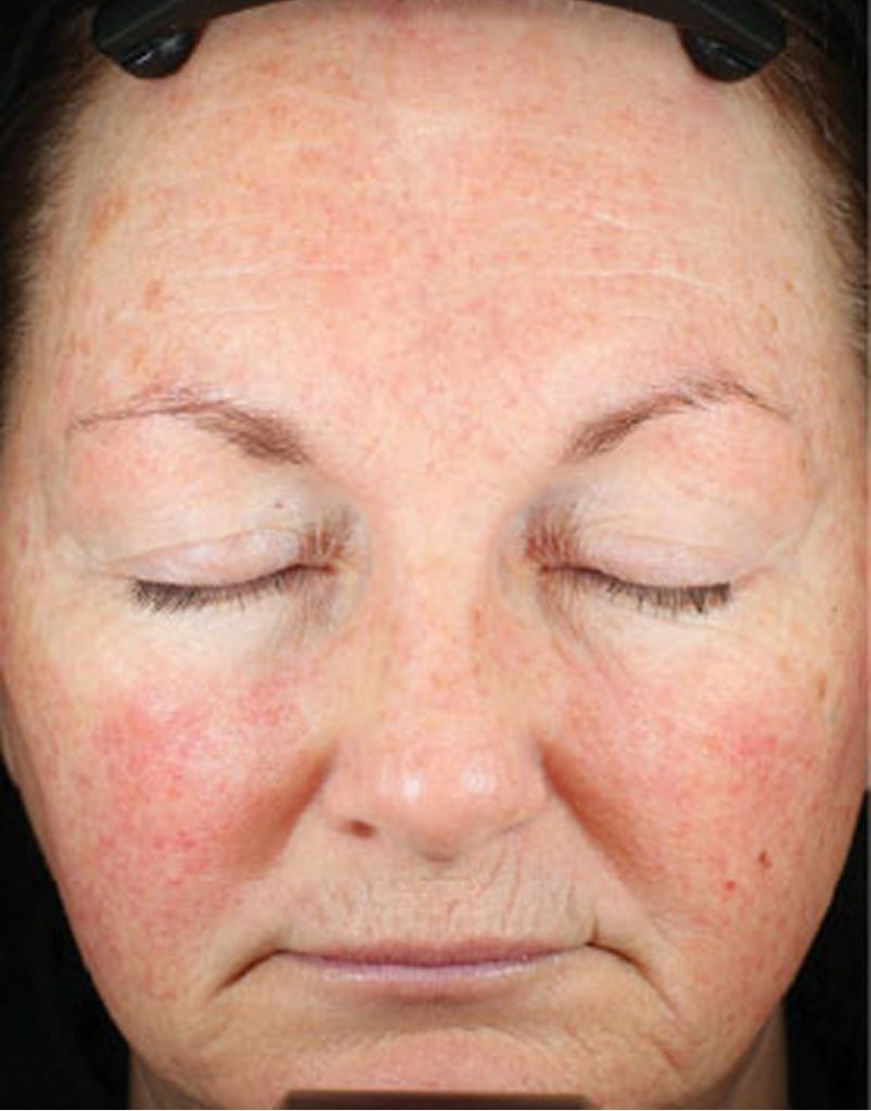 Portrait of woman post-microneedling, 30 days after