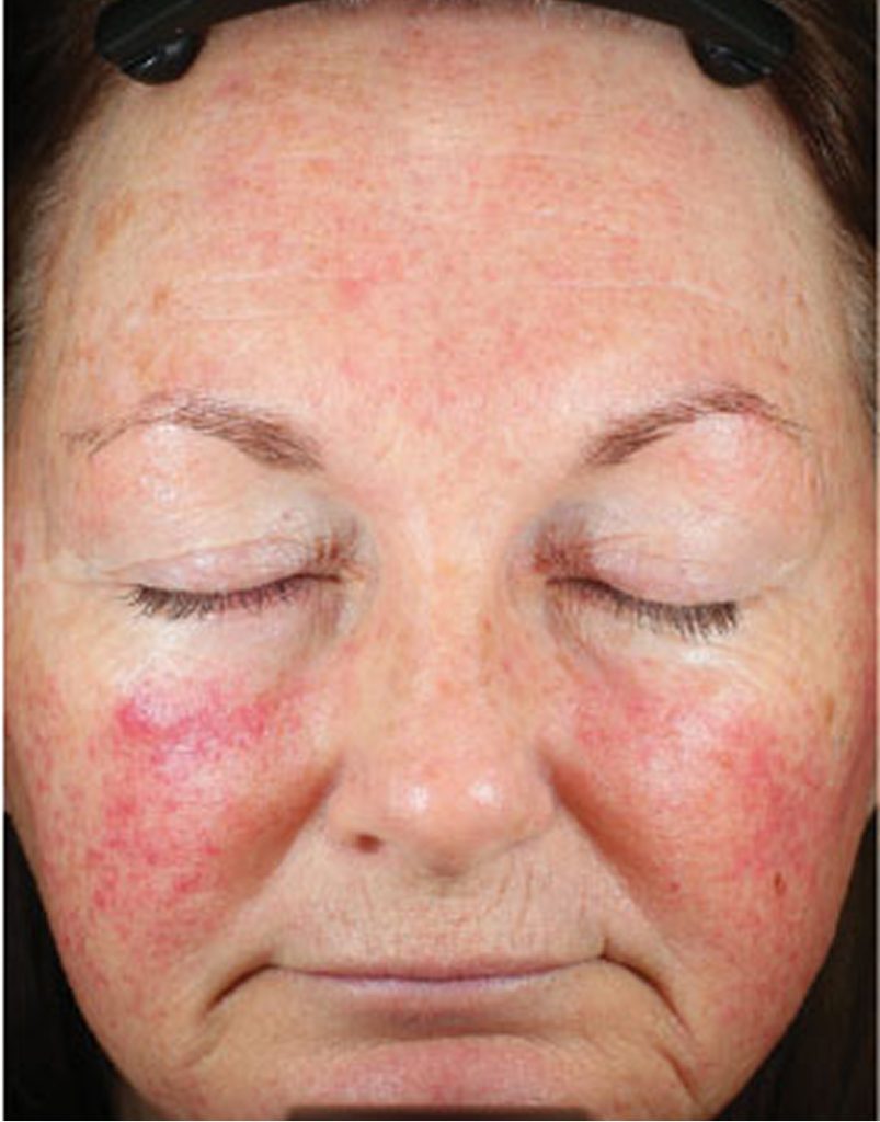 Portrait of woman post-microneedling, immediately after